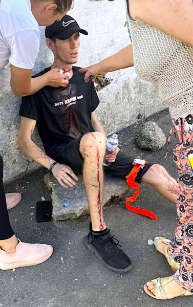 В Ізмаїлі стався вибух снаряда: чоловік отримав травми В Ізмаїлі стався вибух снаряда: чоловік отримав травми