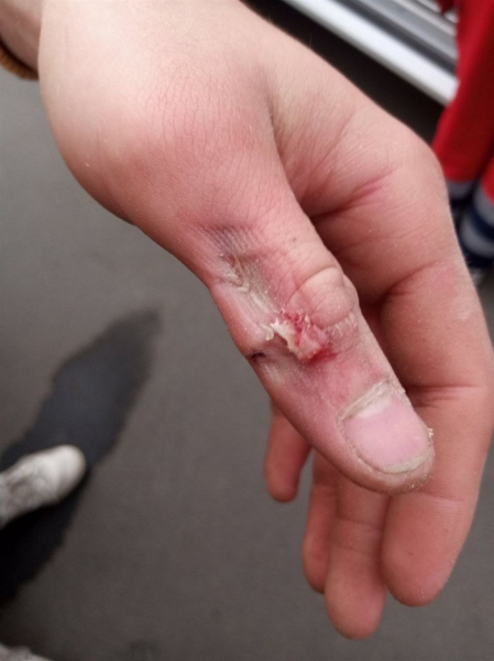 В Ізмаїлі рятувальники визволили руку хлопця зі шліфувальної машинці