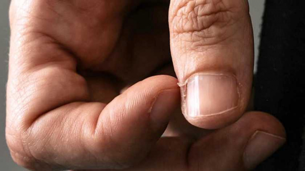 Медики объяснили, почему возникают заусенцы на пальцах и как от них избавиться